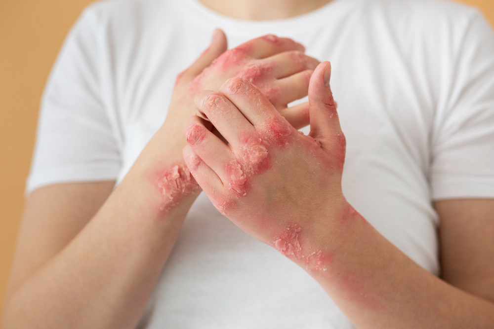 Eksozomların Dermatolojide Kullanımı