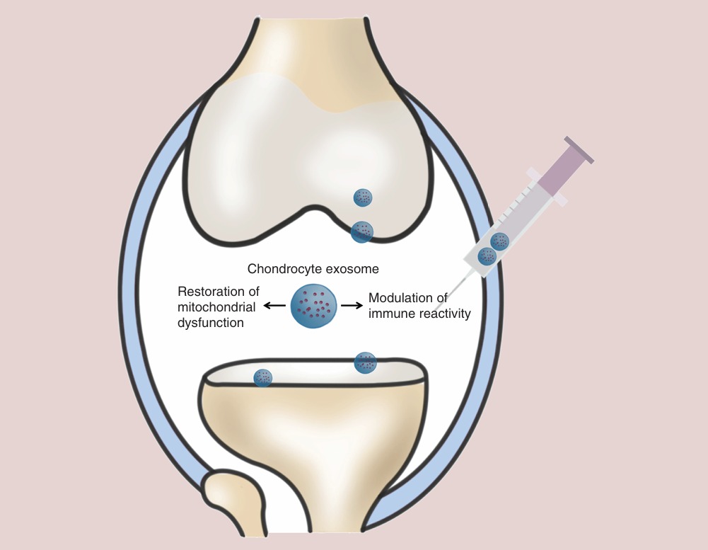 Kondrosit Ekzosomları, Mitokondri ve Bağışıklık Tepkisini Düzenleyerek Osteoartrit Gelişimini Engeller